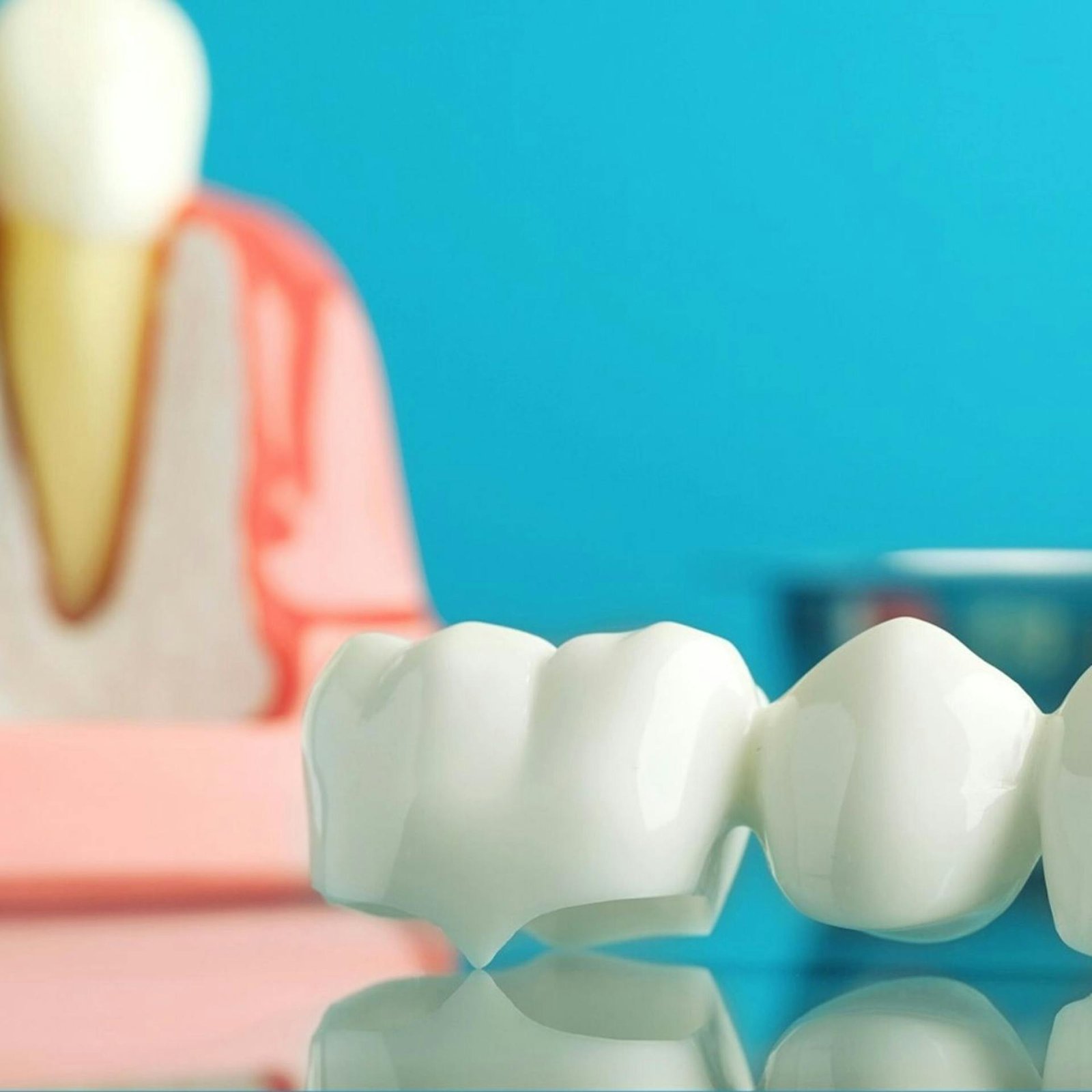 Bridge dentaire posé en bouche — prothèse fixe remplaçant une dent manquante